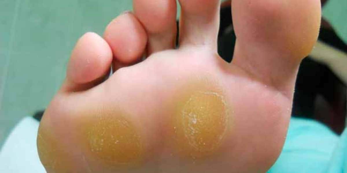 Adeus a calos nos pés com essa receitinha (Foto: Divulgação)