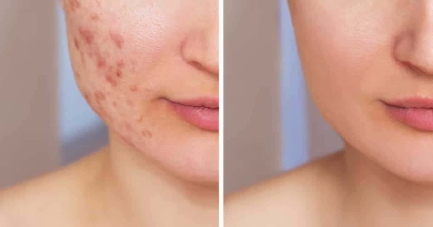 Como tratar cicatriz na pele e sem laser (Foto: Reprodução/ Internet)