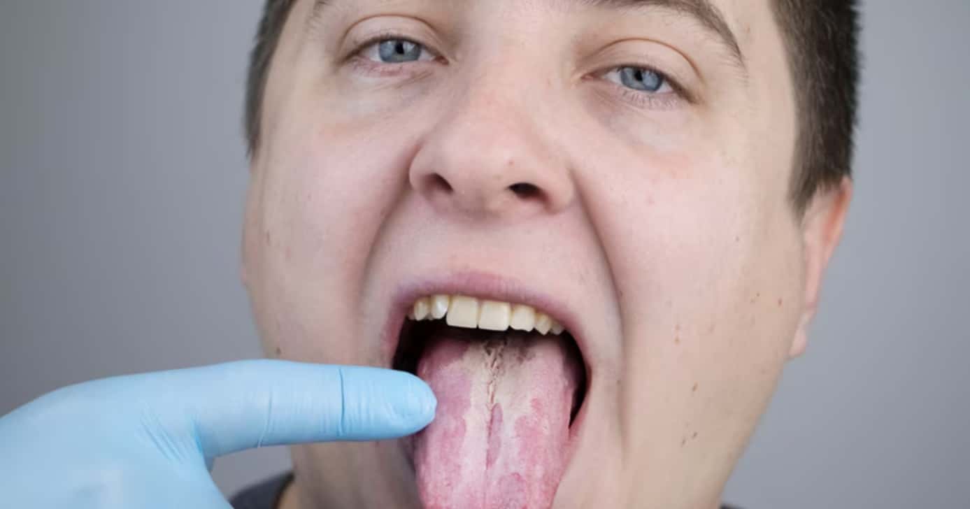 O que a cor da língua diz sobre sua saúde - Foto: Internet