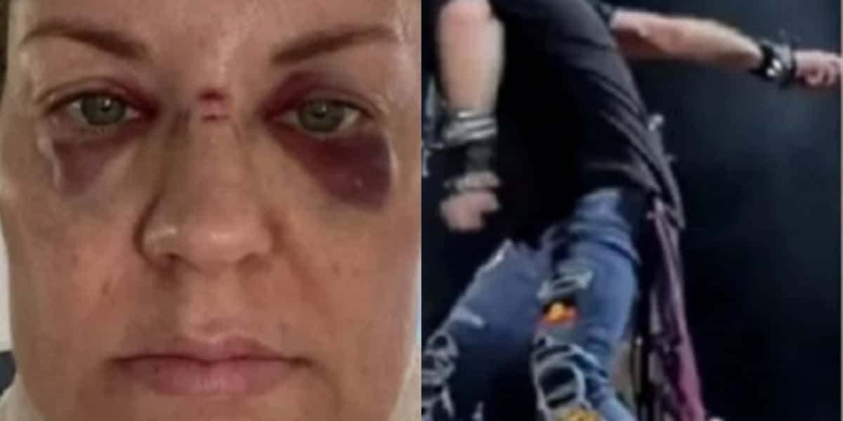 Mulher surgiu com o olho roxo após ser atingida por microfone jogado por cantor (Imagem: Montagem/TV Foco)