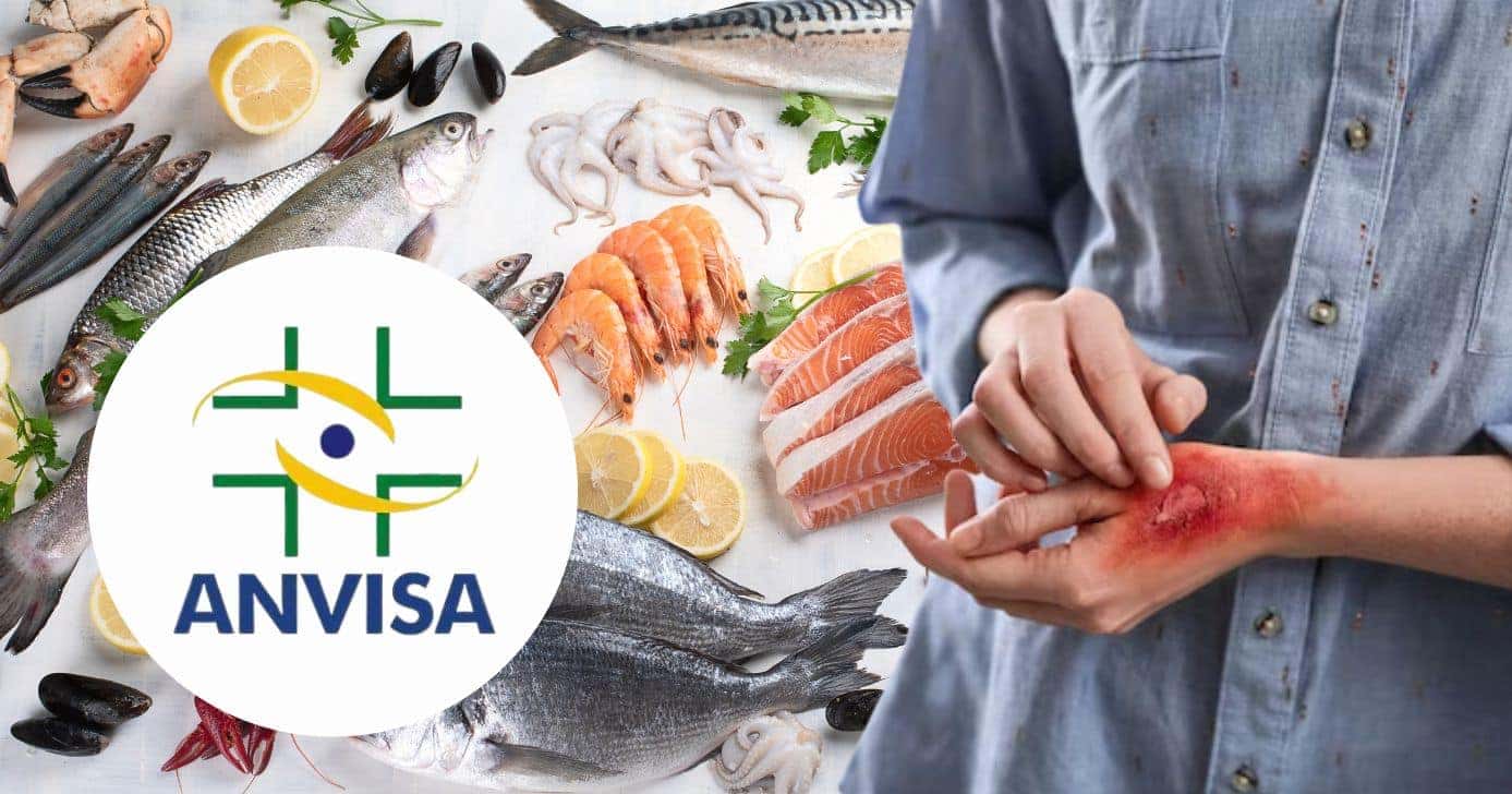 Logo Anvisa, peixes e pessoa com queimaduras (Fotos: Reproduções/ Internet / Canva / Freepik)