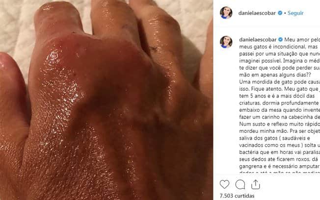 Mão de Daniela Escobar ficou infeccionada após mordida de gato (Foto: Reprodução/Instagram) Mão de Daniela Escobar ficou infeccionada após mordida de gato (Foto: Reprodução/Instagram)