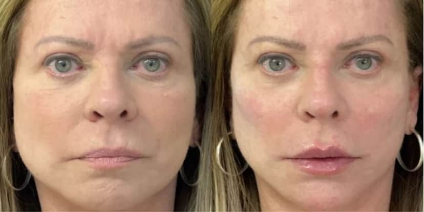 Christina Rocha antes e depois de harmonização facial (Foto: Reprodução/Instagram) Christina Rocha antes e depois de harmonização facial (Foto: Reprodução/Instagram)