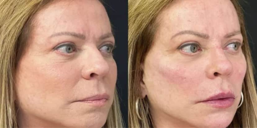 Christina Rocha antes e depois de harmonização facial (Foto: Reprodução/Instagram) Christina Rocha antes e depois de harmonização facial (Foto: Reprodução/Instagram)