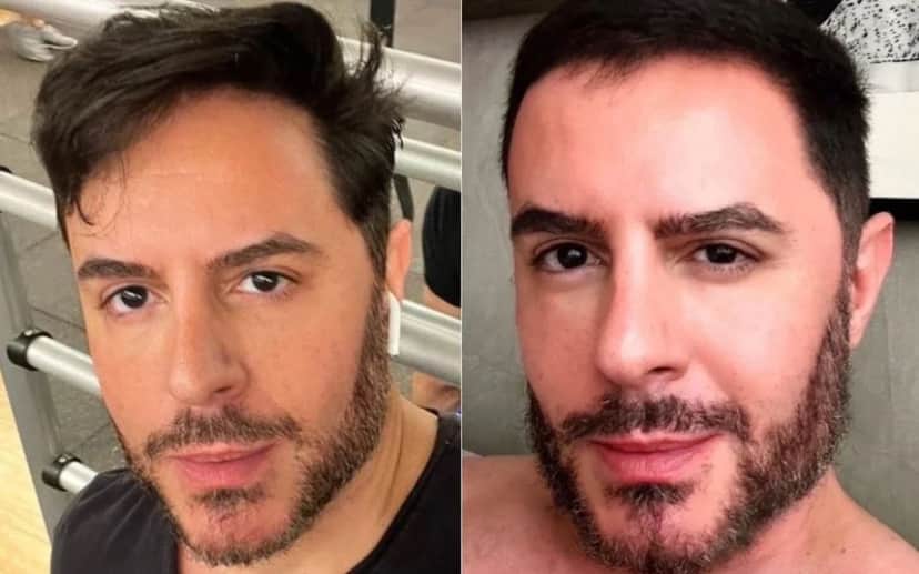 O famoso Ricardo Tozzi, da Globo, passa por procedimento no rosto e antes e depois choca a web - Foto Reprodução O famoso Ricardo Tozzi, da Globo, passa por procedimento no rosto e antes e depois choca a web - Foto Reprodução