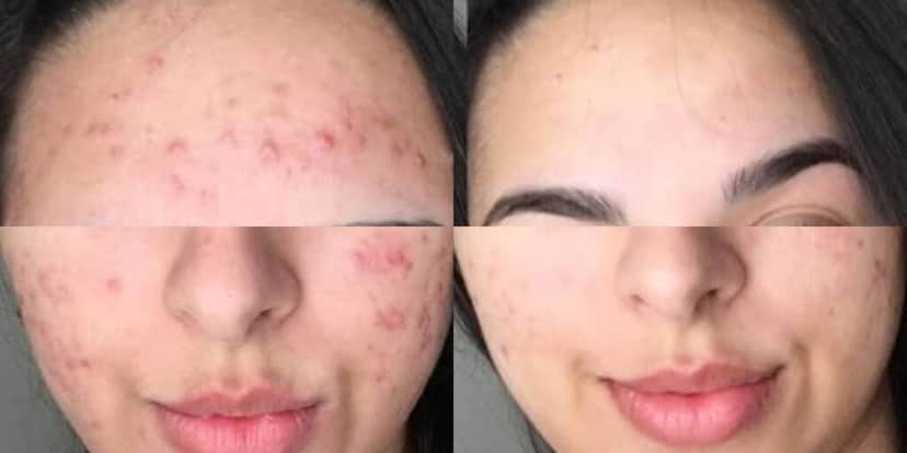 Espinhas e manchas podem ter um fim (Foto: Divulgação) Espinhas e manchas podem ter um fim (Foto: Divulgação)