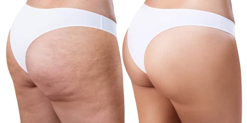 Corpo com e sem celulite (Foto: Reprodução/ Internet) Corpo com e sem celulite (Foto: Reprodução/ Internet)