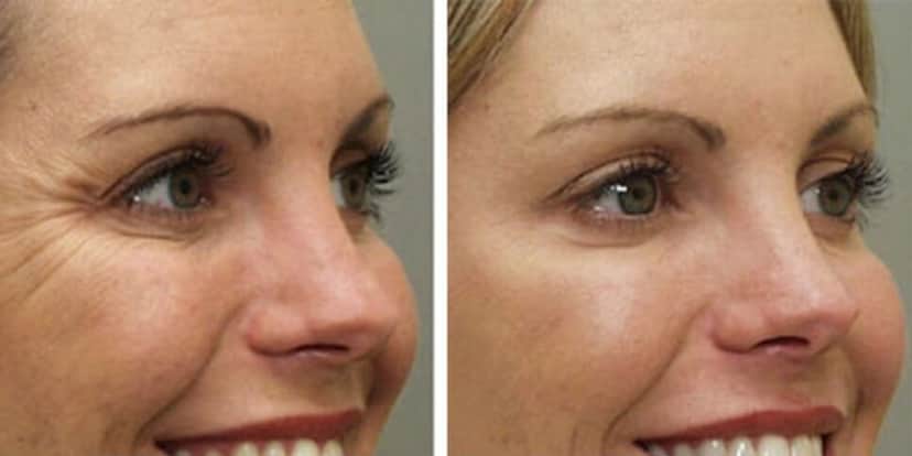 Antes e depois da aplicação do botox (Reprodução: Internet) Antes e depois da aplicação do botox (Reprodução: Internet)