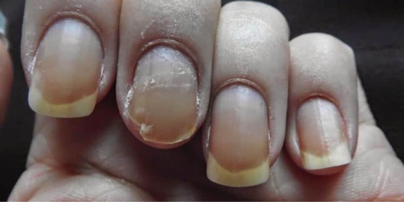 As unhas quebradas são por muitas vezes por falta de cuidado (Reprodução: Internet) As unhas quebradas são por muitas vezes por falta de cuidado (Reprodução: Internet)