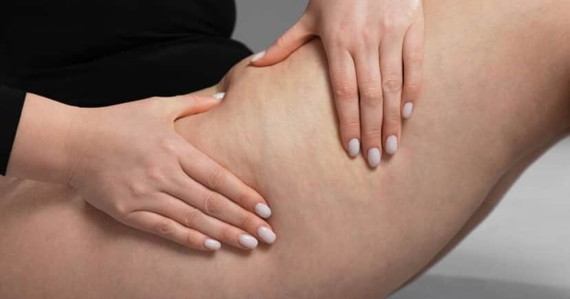 Mulher com celulite (Foto: Canva)