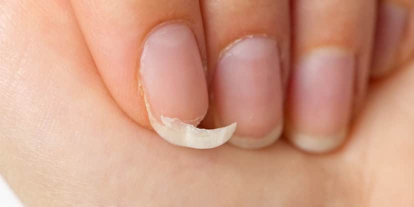 Unhas quebradas revertidas com papel higiênico (Reprodução: Divulgação)