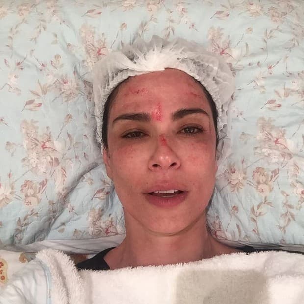 Após tratamento estético, Luciana Gimenez mostra sangue no rosto