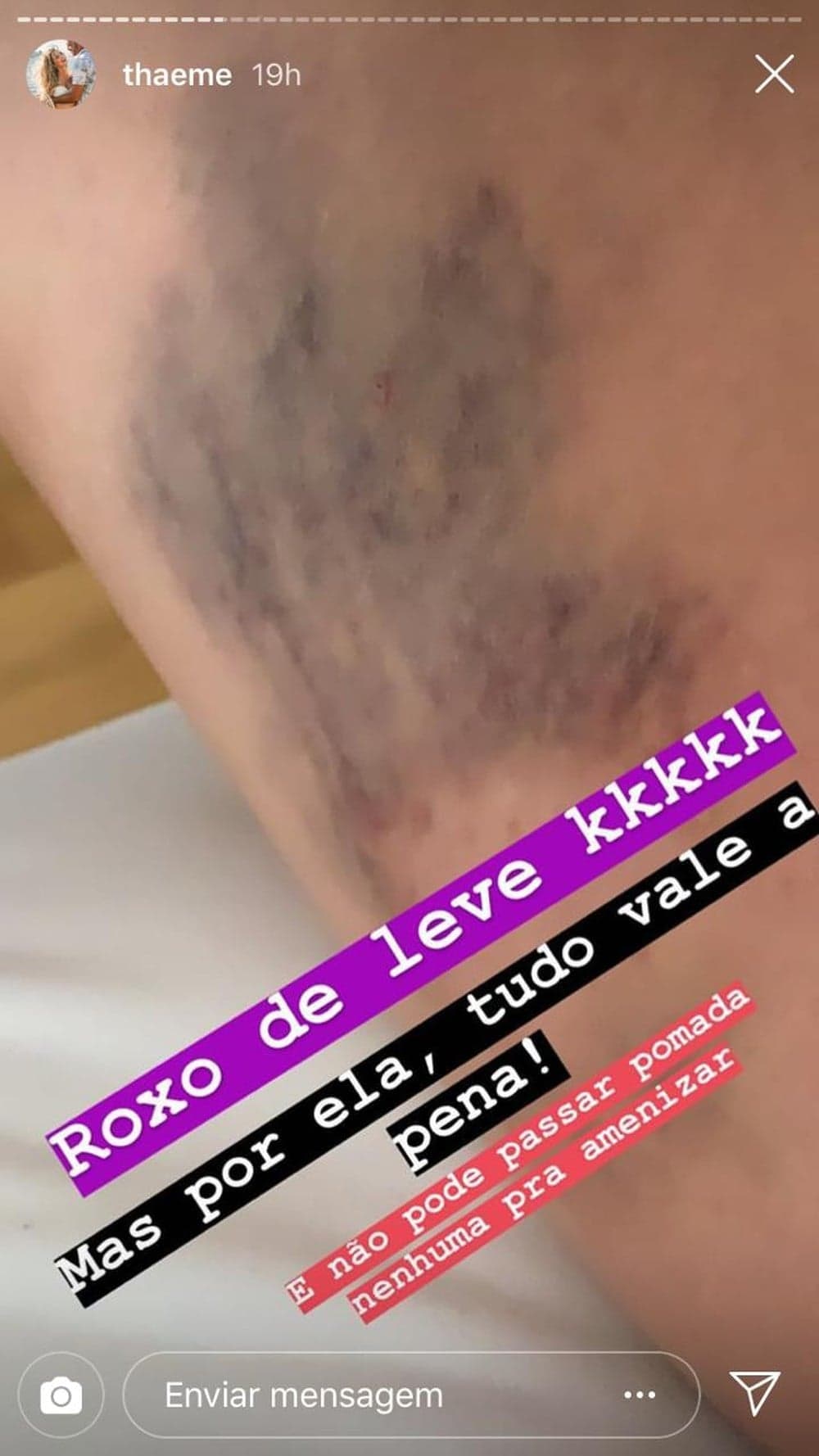 Thaeme mostrou mancha feia no corpo (Foto: Reprodução/Instagram) Thaeme mostrou mancha feia no corpo (Foto: Reprodução/Instagram)