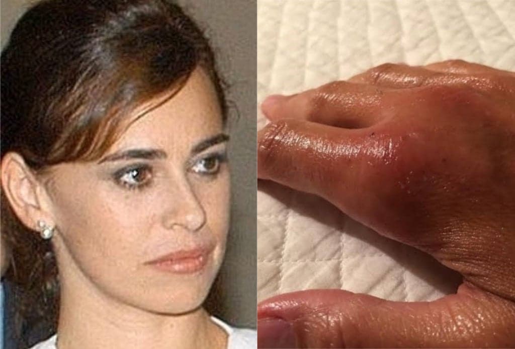 Daniela Escobar após ser mordida por seu gato (Foto: montagem TV Foco)