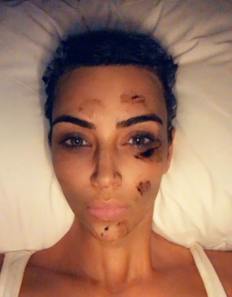 Kim Kardashian sofre de psoríase (Foto: reprodução - Instagram) Kim Kardashian sofre de psoríase (Foto: reprodução - Instagram)