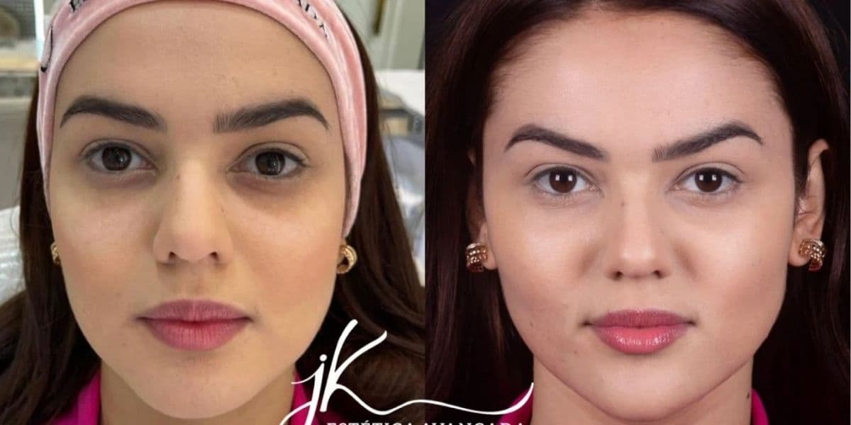 Antes e depois de Eslovênia Marques (DIVULGAÇÃO/ JK ESTÉTICA AVANÇADA) Antes e depois de Eslovênia Marques (DIVULGAÇÃO/ JK ESTÉTICA AVANÇADA)