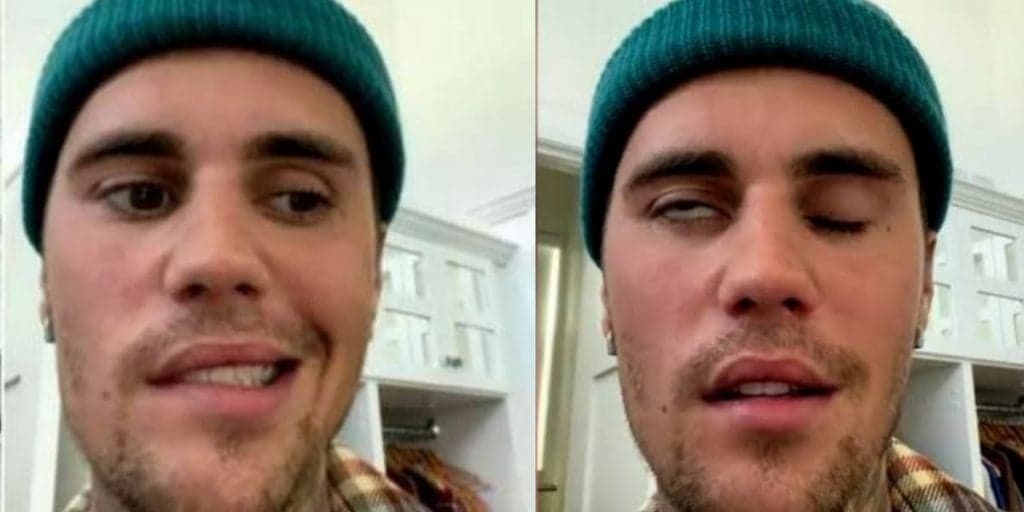 Justin Bieber surge com rosto paralisado, revela síndrome e sofre com sequela: "Orem por mim"