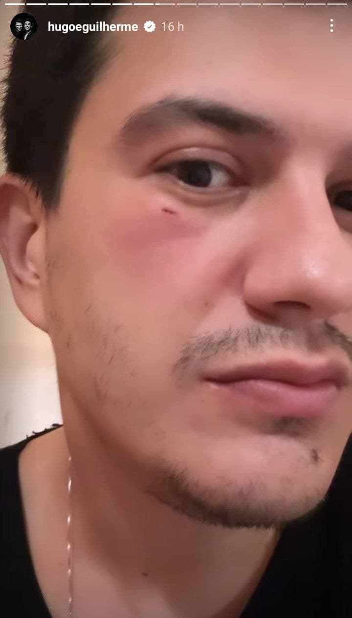 Hugo, da dupla com Guilherme, foi ferido por objeto jogado por fã (Foto: Reprodução/ Instagram) Hugo, da dupla com Guilherme, foi ferido por objeto jogado por fã (Foto: Reprodução/ Instagram)