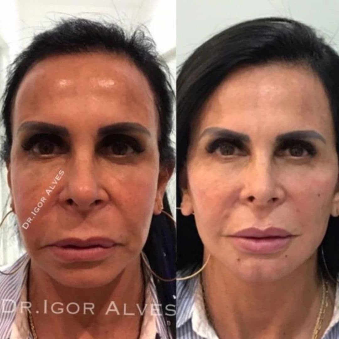 Gretchen surpreendeu os fãs ao aparecer 20 anos mais nova (Reprodução - Instagram) Gretchen surpreendeu os fãs ao aparecer 20 anos mais nova (Reprodução - Instagram)