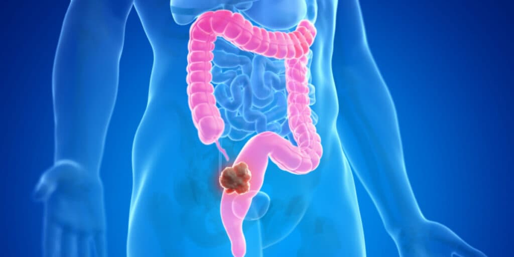 Você está sentido algum deles? Esses são os três principais sintomas para câncer no intestino