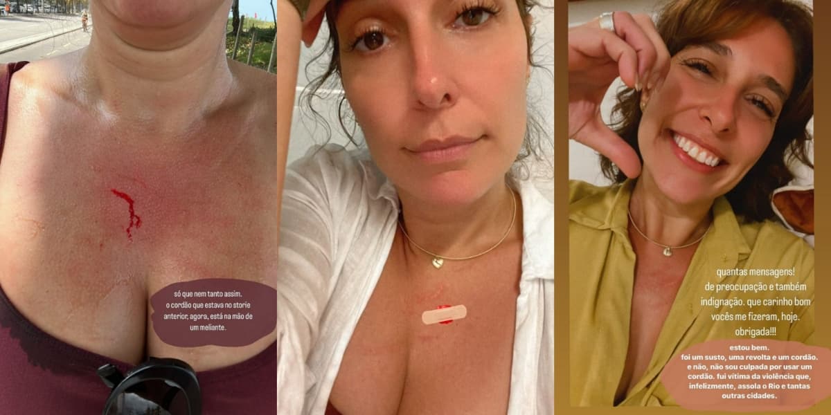 Natasha Dantas, esposa de William Bonner, mostrou busto com sangue após furto (Foto: Reprodução/Instagram) Natasha Dantas, esposa de William Bonner, mostrou busto com sangue após furto (Foto: Reprodução/Instagram)
