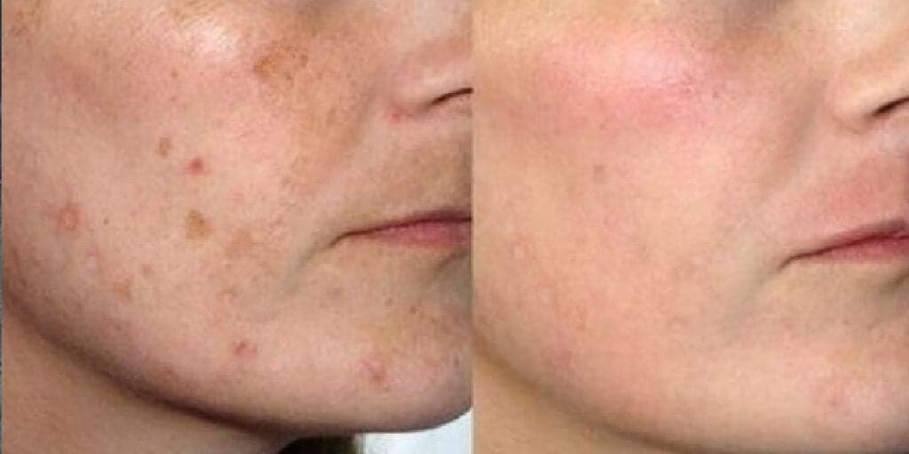 Fim das manchas no rosto em 10 minutos: Misturinha secreta e caseira rejuvenesce 30 anos com 8 ingredientes