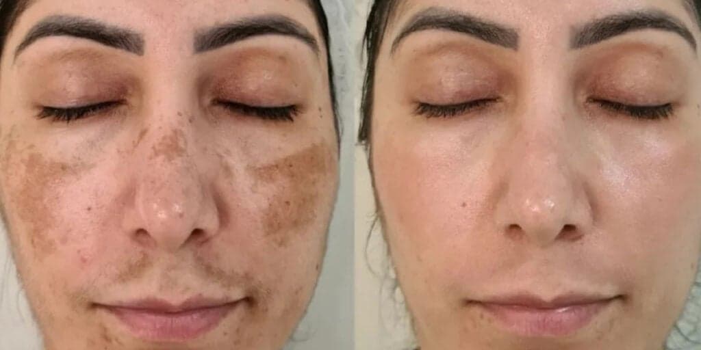 Mais potente que botox: Creminho caseiro com 3 ingredientes dá adeus às manchas e rugas em 5 minutos