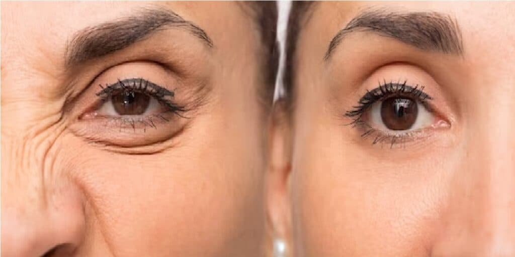 Antienvelhecimento e xô rugas profundas: Misturinha com 3 ingredientes estica a pele e rejuvenesce 30 anos