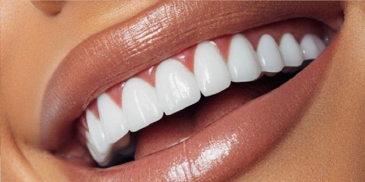 Dentes brilhantes (Foto: Foto: Reprodução/ Internet) Dentes brilhantes (Foto: Foto: Reprodução/ Internet)
