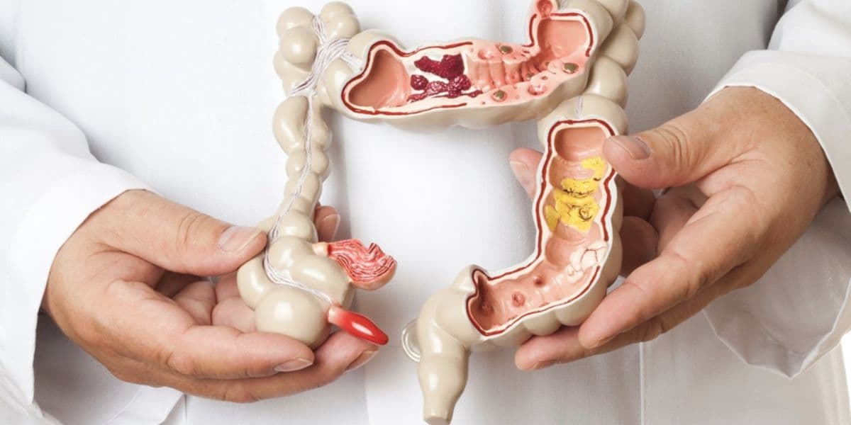 Câncer intestinal (Reprodução/Internet) Câncer intestinal (Reprodução/Internet)