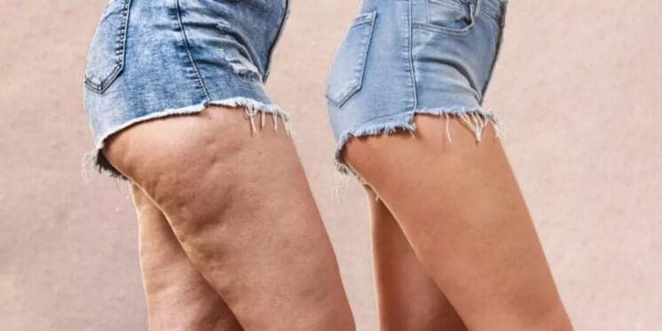 Tchau, celulites: Única bebida popular elimina tormento e te deixa com pernas macias