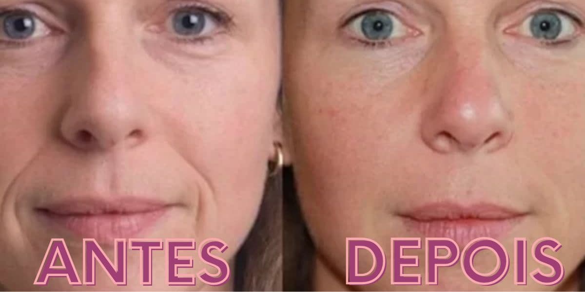 Evolução do extermínio das rugas com a utilização de um único produto (Reprodução: Montagem TV Foco)