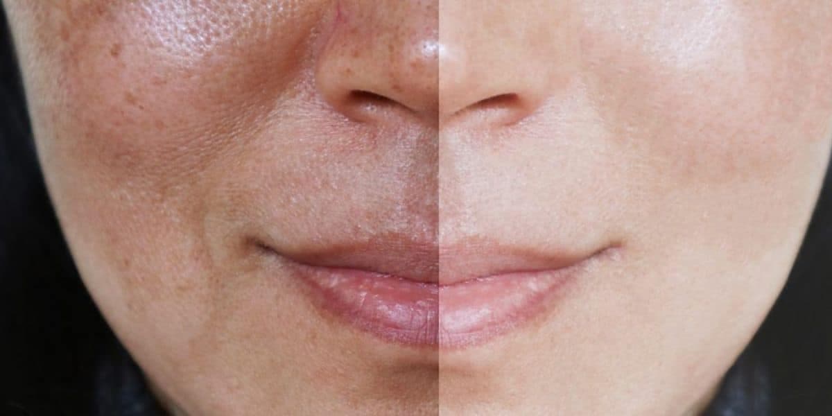 Rosto após dar adeus a melasma (Reprodução: Internet) Rosto após dar adeus a melasma (Reprodução: Internet)