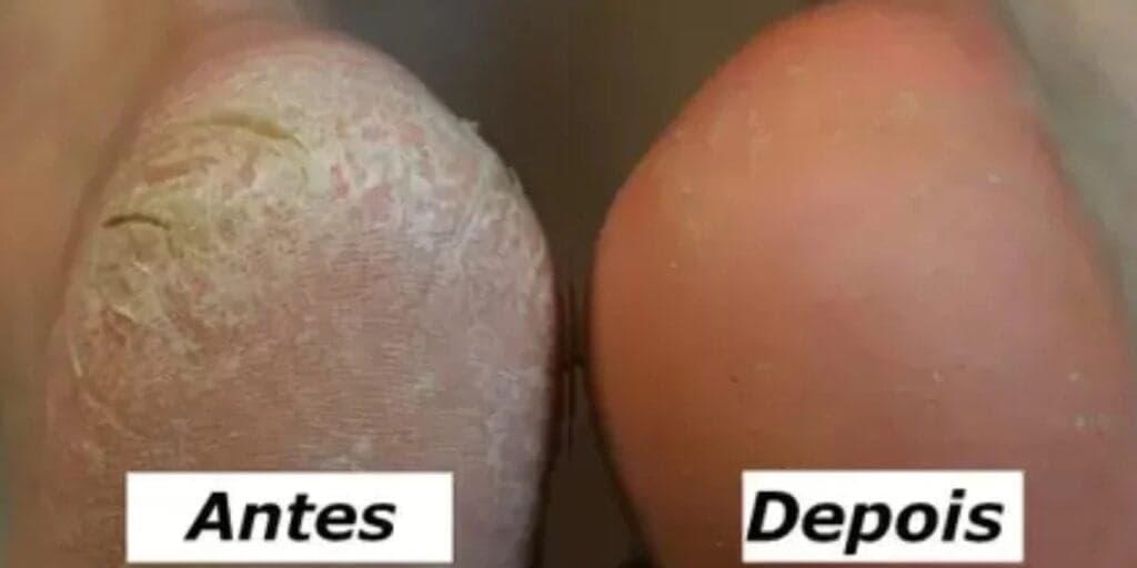 Pés com e sem rachaduras e calos (Foto: Reprodução/ Internet) Pés com e sem rachaduras e calos (Foto: Reprodução/ Internet)