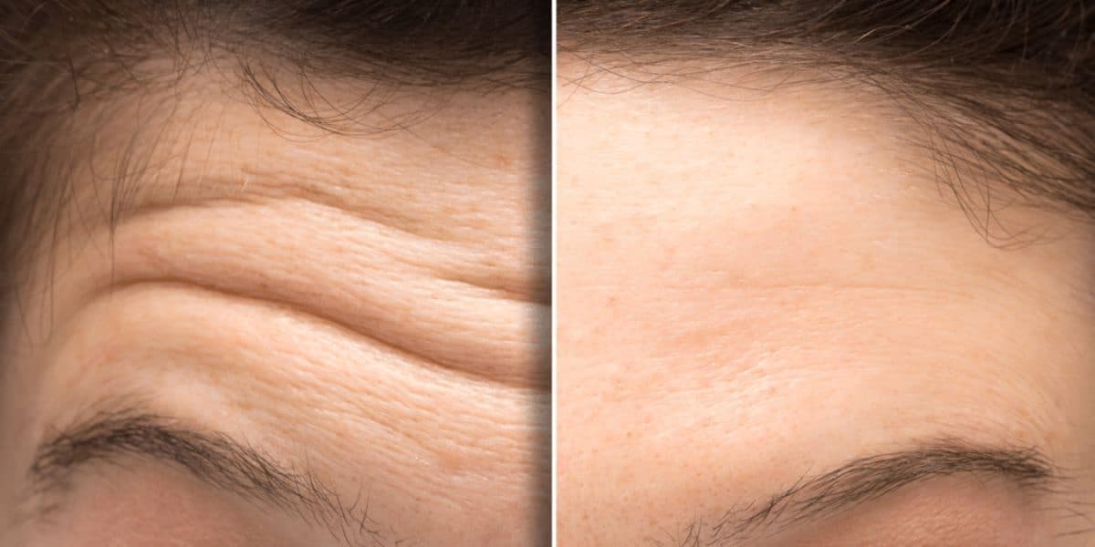 O creme faz as rugas começarem a sumir após 6 dias (Reprodução: Internet) O creme faz as rugas começarem a sumir após 6 dias (Reprodução: Internet)