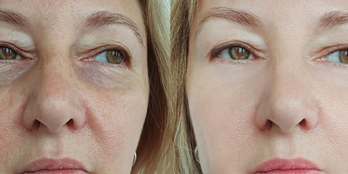 Harmonização 100% natural para rejuvenescer 30 anos (Reprodução: Montagem TV Foco) Harmonização 100% natural para rejuvenescer 30 anos (Reprodução: Montagem TV Foco)