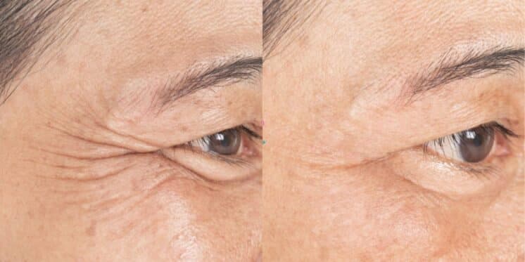 harmonização caseira para rejuvenescer em 10 anos as idosas (Reprodução: Montagem TV Foco) harmonização caseira para rejuvenescer em 10 anos as idosas (Reprodução: Montagem TV Foco)