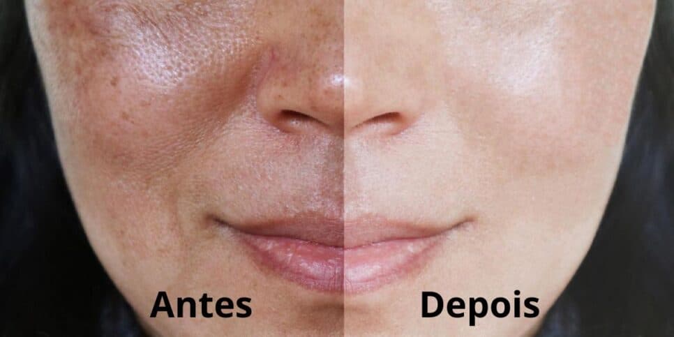 Manchas escuras aniquiladas e rejuvenesce na hora: Peeling natural está salvando a pele das mulheres em 4 passos
