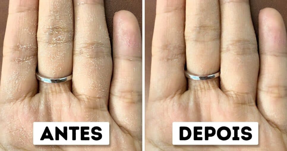 Mãos 30 anos mais jovem: Misturinha caseira com apenas 3 ingredientes e em 5 minutos dá adeus ao ressecamento e aos calos