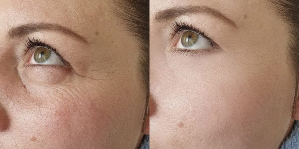 Fim do Botox com 1 único produto: 3 receitinhas livre de químicas deixam as 50+ sem rugas para sempre