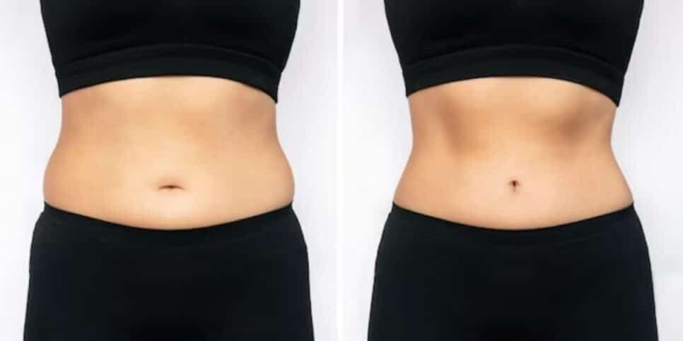 Mulher com e sem gordura localizada na região da barriga (Foto: Reprodução/ Freepik) Mulher com e sem gordura localizada na região da barriga (Foto: Reprodução/ Freepik)