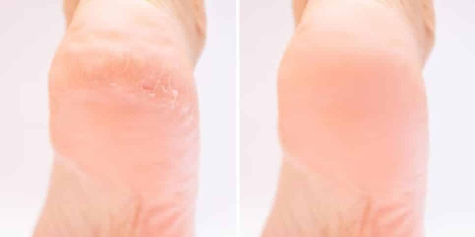 Fim do ressecamento e calos: Mistura com 3 ingredientes deixa os pés macios como de bebês em 20 minutos
