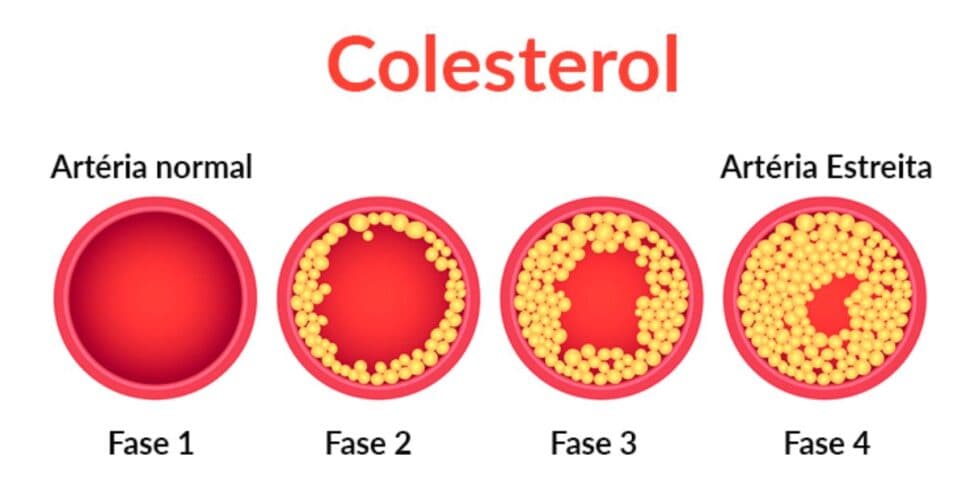 Colesterol (Reprodução/Unifesp) Colesterol (Reprodução/Unifesp)