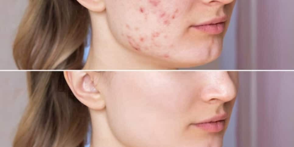 Elimina espinhas e cravos: 2 únicos ingredientes te dão pele de bebê