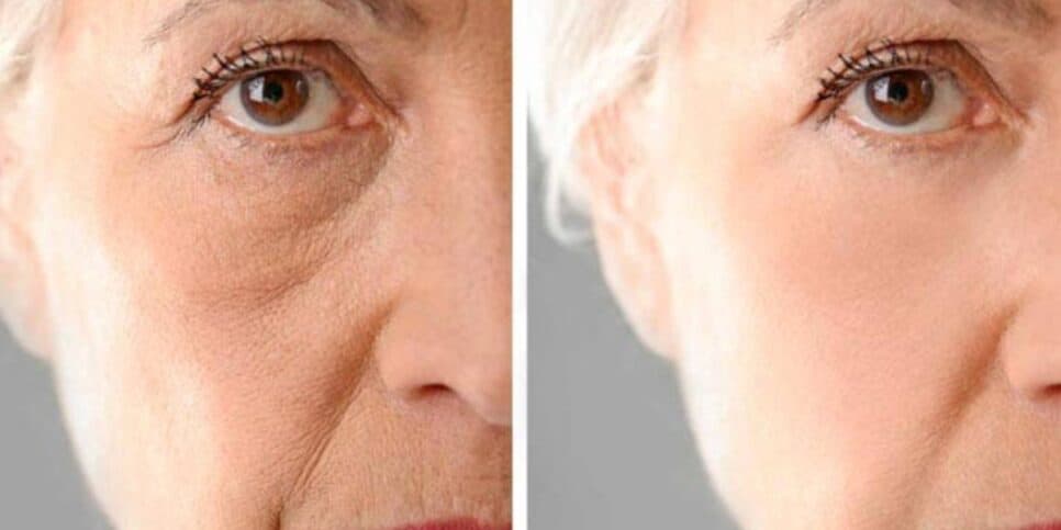 FIM do botox: Harmonização caseira transforma o rosto em 15 minutos e rejuvenesce idosas 20 anos