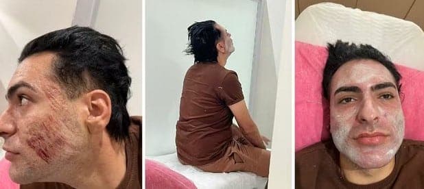 Henrique Chagas ficou com ferimentos no rosto após peeling de fenol (Foto: Reprodução / Marcelo Camargo)
Henrique Chagas ficou com ferimentos no rosto após peeling de fenol (Foto: Reprodução / Marcelo Camargo)