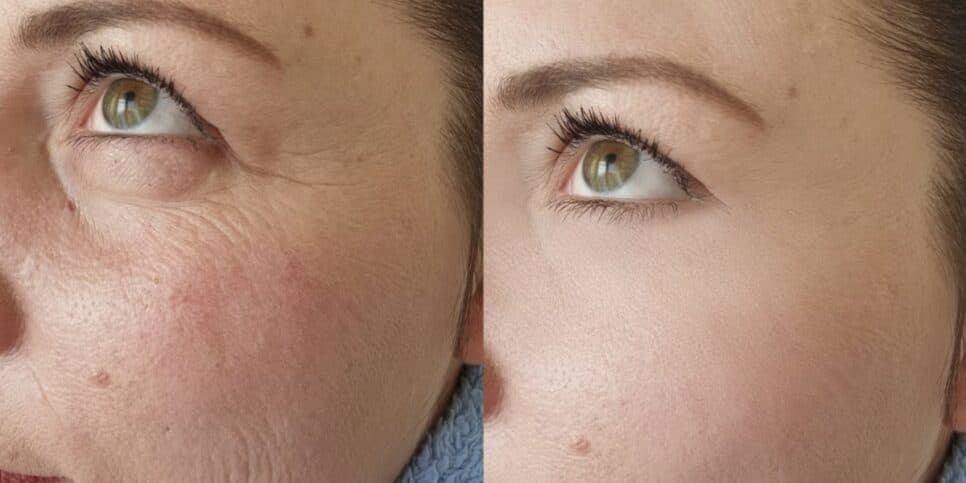 Falência das clínicas de estética: Ácido hialurônico caseiro com 5 ingredientes suga rugas das 60+