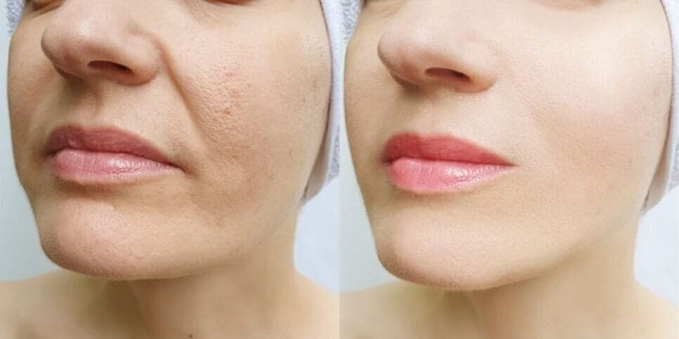 Adeus rugas: 1 ingrediente secreto elimina rugas e estica pele em 30 minutos
