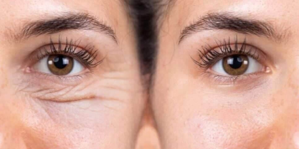 Harmonização facial com 2 ingredientes dá fim ao pé de galinha em 20 minutos