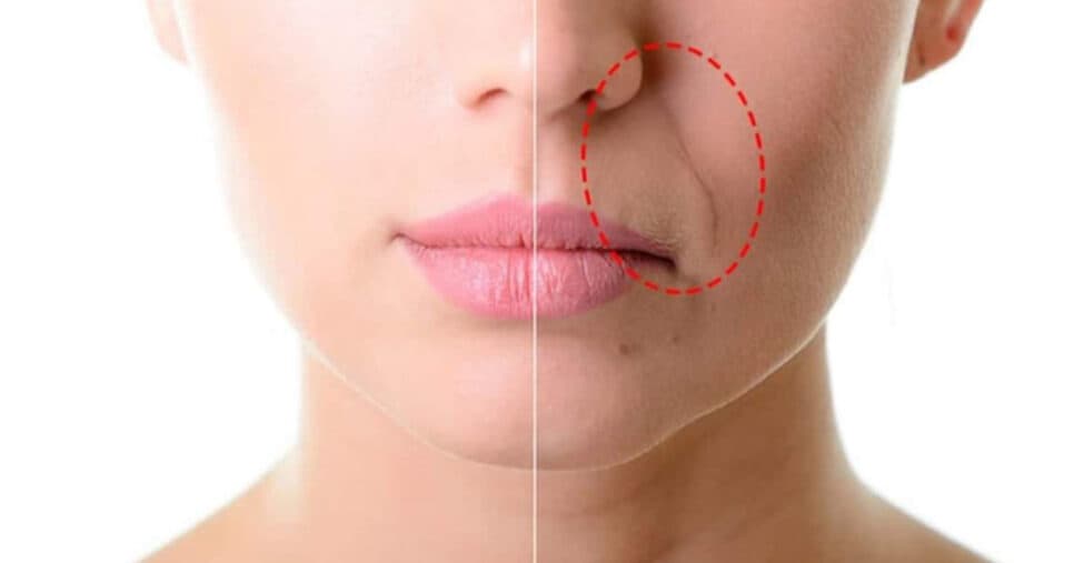 Graças a essa receita você vai se livrar do bigode chinês e das rugas (Foto: Montagem) Graças a essa receita você vai se livrar do bigode chinês e das rugas (Foto: Montagem)